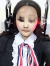 Cheekbone Reduction & V-Line Surgery — Korea cost, reviews & before-after | MISOODA