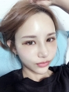 Double Eyelid Revision (Natural adhesion method+Ptosis correction) — Korea cost, reviews & before-after | MISOODA