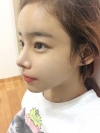 Eye surgery (Natural adhesion+ Ptosis correction) + Nasal bridge+Nasal tip — Korea cost, reviews & before-after | MISOODA