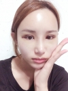 Double Eyelid Revision (Natural adhesion method+Ptosis correction) — Korea cost, reviews & before-after | MISOODA