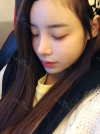 Eye surgery (Natural adhesion+ Ptosis correction) + Nasal bridge+Nasal tip — Korea cost, reviews & before-after | MISOODA