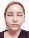 Double Eyelid Revision (Natural adhesion method+Ptosis correction) — Korea cost, reviews & before-after | MISOODA