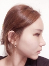 Double Eyelid Revision (Natural adhesion method+Ptosis correction) — Korea cost, reviews & before-after | MISOODA