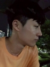 Nasal bridge+Nasal tip surgery / used nasal septum — Korea cost, reviews & before-after | MISOODA