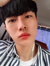 Nasal bridge+Nasal tip surgery / used nasal septum — Korea cost, reviews & before-after | MISOODA