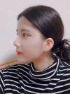 Double Eyelid Revision (Natural adhesion method+Ptosis correction+Dual Epi) + Nasal bridge + Nasal tip — Korea cost, reviews & before-after | MISOODA
