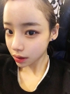 Eye surgery (Natural adhesion+ Ptosis correction) + Nasal bridge+Nasal tip — Korea cost, reviews & before-after | MISOODA
