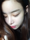Eye surgery (Natural adhesion+ Ptosis correction) + Nasal bridge+Nasal tip — Korea cost, reviews & before-after | MISOODA