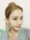 Double Eyelid Revision (Natural adhesion method+Ptosis correction) — Korea cost, reviews & before-after | MISOODA