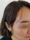 My Hairline Hair Transplant Surgery in Yonsei Hair Transplant clinic — Korea cost, reviews & before-after | MISOODA