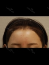 MISOODA — Korea cost, reviews & before-after | MISOODA
