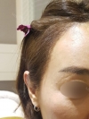 MISOODA — Korea cost, reviews & before-after | MISOODA