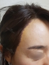 My Hairline Hair Transplant Surgery in Yonsei Hair Transplant clinic — Korea cost, reviews & before-after | MISOODA