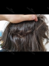 My Hairline Hair Transplant Surgery in Yonsei Hair Transplant clinic — Korea cost, reviews & before-after | MISOODA