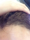Hairline transplant surgery (after 7 months) — Korea cost, reviews & before-after | MISOODA