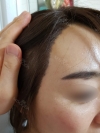 My Hairline Hair Transplant Surgery in Yonsei Hair Transplant clinic — Korea cost, reviews & before-after | MISOODA