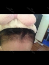 Hairline transplant surgery (after 7 months) — Korea cost, reviews & before-after | MISOODA