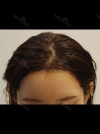 Hairline transplant surgery (after 7 months) — Korea cost, reviews & before-after | MISOODA