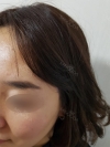 My Hairline Hair Transplant Surgery in Yonsei Hair Transplant clinic — Korea cost, reviews & before-after | MISOODA