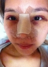 Plastic glasses?? No problem!! — Korea cost, reviews & before-after | MISOODA