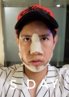 TYPES OF SURGERY: V-LINE, NOSE REVISION, NOSTRIL REDUCTION & FAT GRAFTING — Korea cost, reviews & before-after | MISOODA