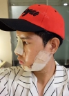 TYPES OF SURGERY: V-LINE, NOSE REVISION, NOSTRIL REDUCTION & FAT GRAFTING — Korea cost, reviews & before-after | MISOODA