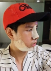 TYPES OF SURGERY: V-LINE, NOSE REVISION, NOSTRIL REDUCTION & FAT GRAFTING — Korea cost, reviews & before-after | MISOODA