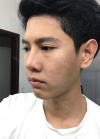 TYPES OF SURGERY: V-LINE, NOSE REVISION, NOSTRIL REDUCTION & FAT GRAFTING — Korea cost, reviews & before-after | MISOODA