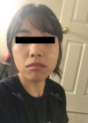 lip curl/mouth corner surgery — Korea cost, reviews & before-after | MISOODA