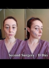 Rhinoplasty + Fat graft + PRP + Eye bag removal + Thread Lift + Lip Filler — Korea cost, reviews & before-after | MISOODA