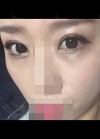 Incision Ptosis Revision — Korea cost, reviews & before-after | MISOODA