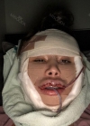 Upper lip reduction, cheek bone, square jaw reduction, fat grafting — Korea cost, reviews & before-after | MISOODA