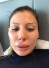 Upper lip reduction, cheek bone, square jaw reduction, fat grafting — Korea cost, reviews & before-after | MISOODA