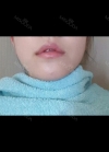 I had Smile lip lifting, Cupid’s bow lip and lip tubercle surgeries in Hyundai Aesthetics. — Korea cost, reviews & before-after | MISOODA