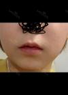 I wanted to have smile lifting surgery — Korea cost, reviews & before-after | MISOODA