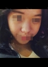 Nose Revision — Korea cost, reviews & before-after | MISOODA