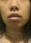 lip curl/mouth corner surgery — Korea cost, reviews & before-after | MISOODA