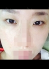 Incision Ptosis Revision — Korea cost, reviews & before-after | MISOODA