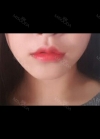 MISOODA — Korea cost, reviews & before-after | MISOODA