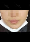 I really recommend it to those who have flat lips like me. — Korea cost, reviews & before-after | MISOODA