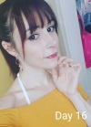 Rhinoplasty + Fat graft + PRP + Eye bag removal + Thread Lift + Lip Filler — Korea cost, reviews & before-after | MISOODA