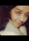 Nose Revision — Korea cost, reviews & before-after | MISOODA