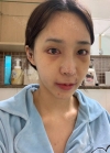 Endotine thread lifting, Epicanthoplasty, Nose revision surgery, lip tip lift — Korea cost, reviews & before-after | MISOODA