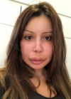 Upper lip reduction, cheek bone, square jaw reduction, fat grafting — Korea cost, reviews & before-after | MISOODA