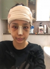 Endotine thread lifting, Epicanthoplasty, Nose revision surgery, lip tip lift — Korea cost, reviews & before-after | MISOODA