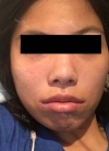 lip curl/mouth corner surgery — Korea cost, reviews & before-after | MISOODA