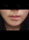 I absolutely love my lips!!! — Korea cost, reviews & before-after | MISOODA