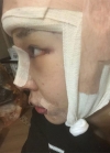 Endotine thread lifting, Epicanthoplasty, Nose revision surgery, lip tip lift — Korea cost, reviews & before-after | MISOODA