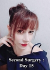 Rhinoplasty + Fat graft + PRP + Eye bag removal + Thread Lift + Lip Filler — Korea cost, reviews & before-after | MISOODA