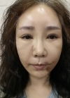 eye, nose, face lifting, fat grafting — Korea cost, reviews & before-after | MISOODA
